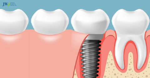 Công nghệ trồng răng Implant AI: Giải pháp hiện đại, an toàn và tiên tiến