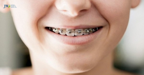Giải pháp niềng răng là gì và một số lợi ích quan trọng 