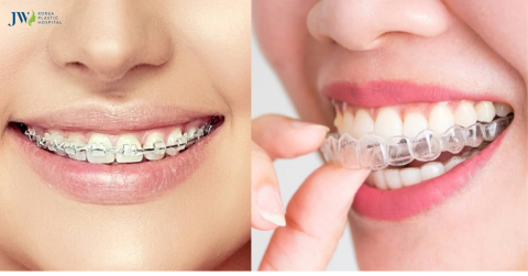 Những hiểu lầm về niềng răng trong suốt AI, bạn đã biết chưa?