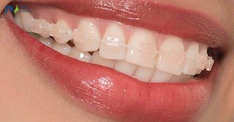 Hướng dẫn sử dụng niềng răng trong suốt AI đúng cách và đạt hiệu quả