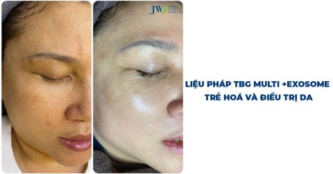 Multi+ Exosome: Liệu pháp và trẻ hóa làn da độc quyền tại JW 