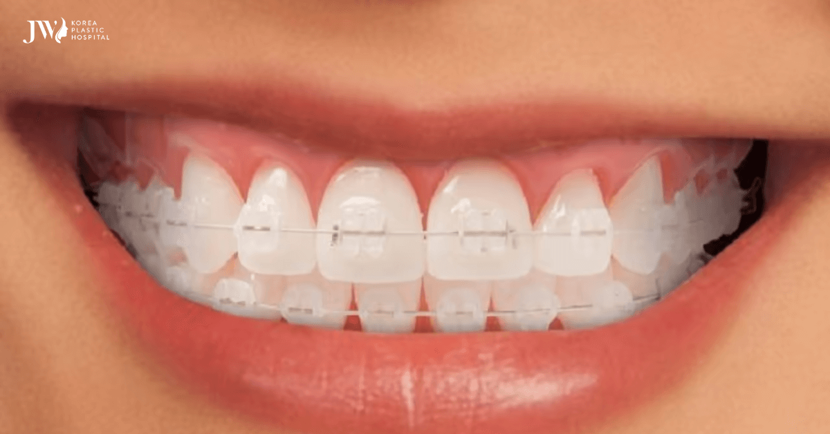 Niềng răng mắc cài sứ trong suốt – Phương pháp chỉnh nha hiện đại