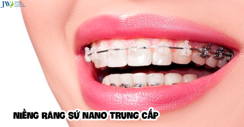 Niềng răng sứ Nano trung cấp và những điều cần lưu ý