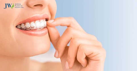 Niềng răng trong suốt AI phù hợp cho đối tượng nào? Lộ trình niềng ra sao?