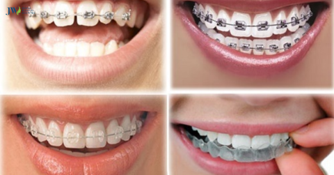 MỘT SỐ PHƯƠNG PHÁP CHỈNH NHA HIỆN ĐẠI NHẤT HIỆN NAY 