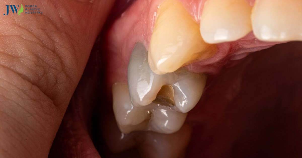 Răng chết tủy có niềng răng được không?