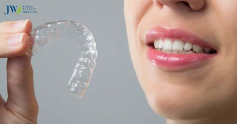 Thời gian niềng răng trong suốt AI bao lâu? Bệnh viện JW giải đáp