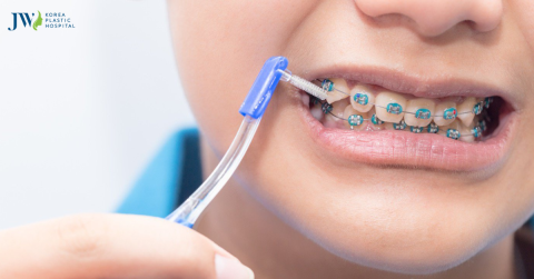16 tuổi chi phí niềng răng bao nhiêu thế nào? Làm sao để tiết kiệm