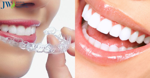 Nên lựa chọn niềng răng hay bọc sứ?