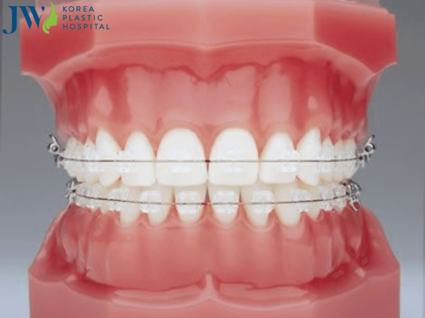 Quá trình niềng răng ảnh hưởng đến phát âm hay không?