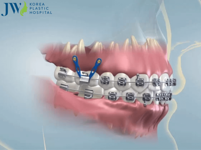 Quá trình niềng răng ảnh hưởng đến phát âm hay không?