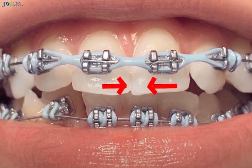 Các loại thun niềng răng phổ biến và tính năng của chúng 2