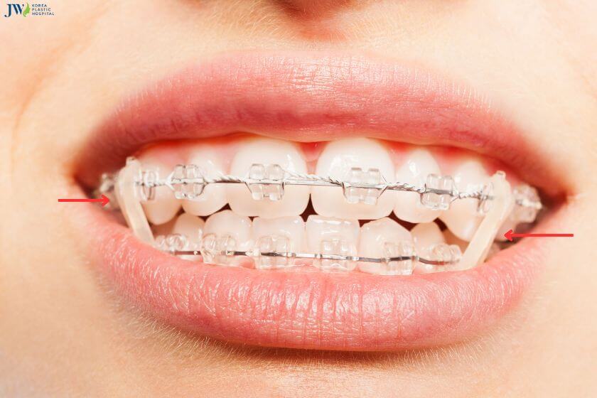 Các loại thun niềng răng phổ biến và tính năng của chúng 3