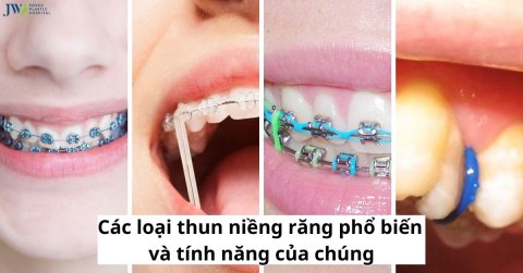 Các loại thun niềng răng phổ biến và tính năng của chúng