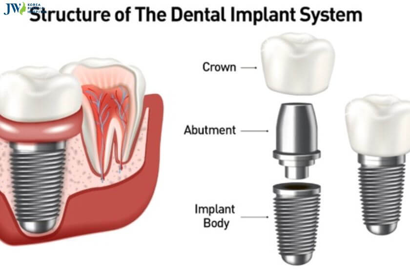 Chi phí của các loại trồng răng Implant 1