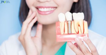 Chi phí của các loại trồng răng Implant