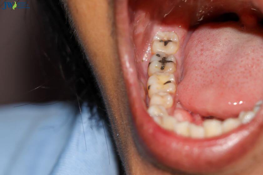 Có nên niềng răng khi bị sâu răng không? 1