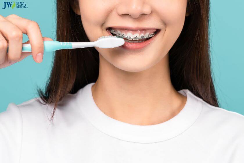 Có nên niềng răng khi bị sâu răng không? 2