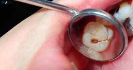 Có nên niềng răng khi bị sâu răng không? thumb