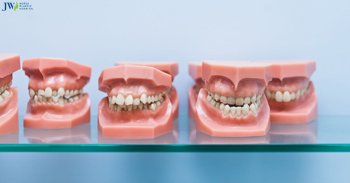 Lệch khớp cắn là gì? Niềng răng có trị lệch khớp cắn được không?