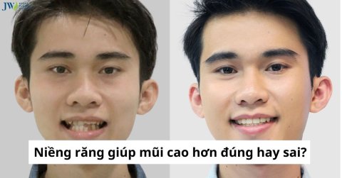 Niềng răng có làm mũi cao hơn không?