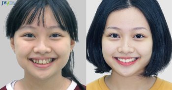 Niềng răng có thể tạo ra những thay đổi gì trên khuôn mặt bạn?