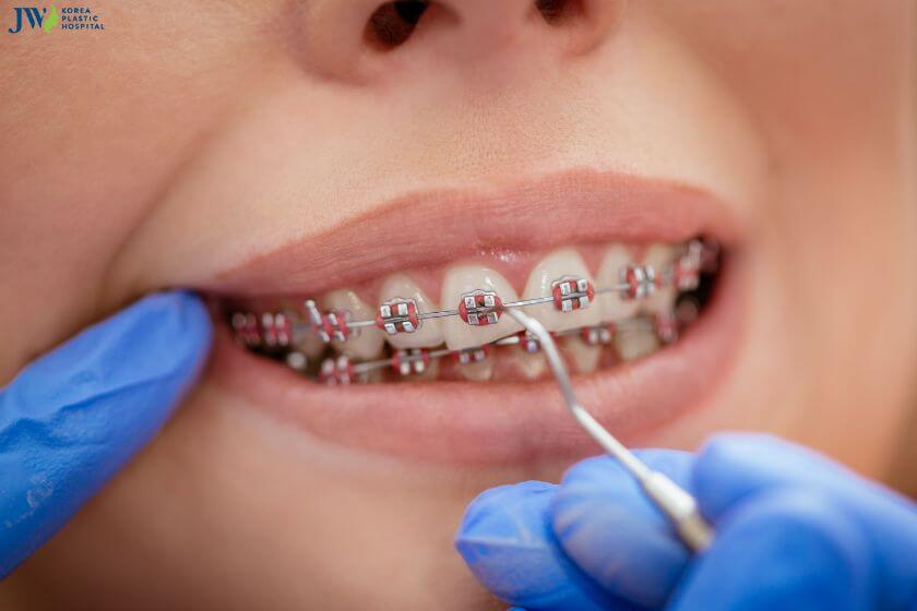 Niềng răng không cần phẫu thuật: Đúng hay sai? 1