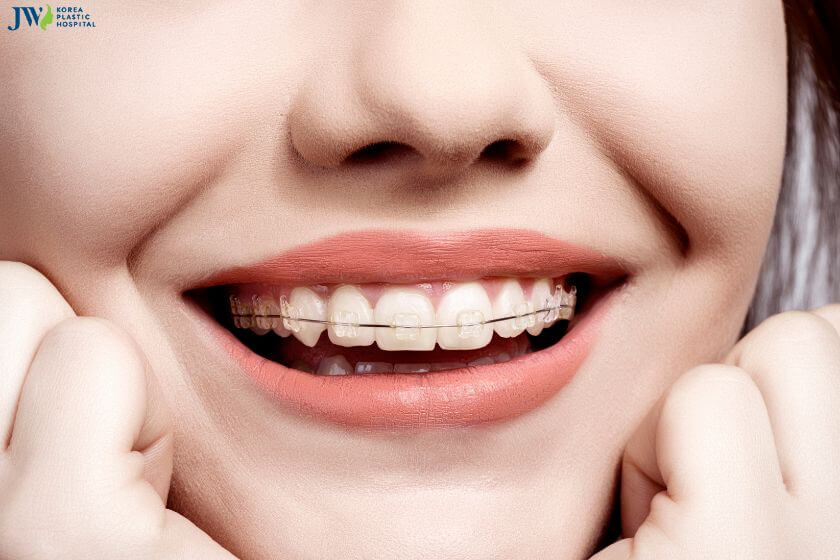 Niềng răng không cần phẫu thuật: Đúng hay sai? 2