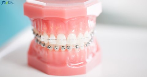 Niềng răng không cần phẫu thuật: Đúng hay sai?