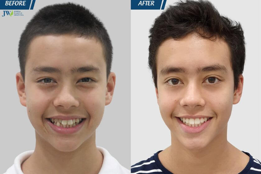Niềng răng thay đổi góc hàm