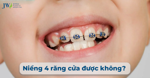 Niềng 4 Răng Cửa Được Không? Chi Phí Bao Nhiêu