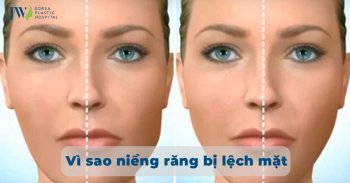 Niềng răng bị lệch mặt: Một số nguyên nhân và cách khắc phục