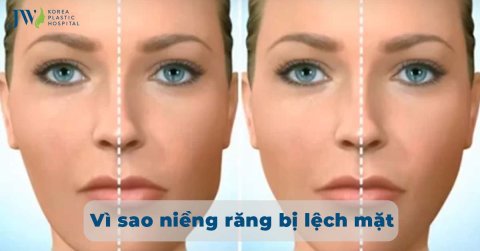 Niềng răng bị lệch mặt: Một số nguyên nhân và cách khắc phục