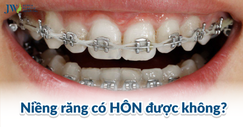 Niềng Răng Có Hôn Được Không? Những Mẹo Nhỏ Bạn Cần Biết