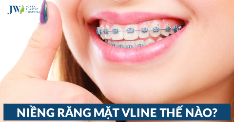 Niềng răng mặt VLine – Giúp răng đẹp và cằm thon gọn