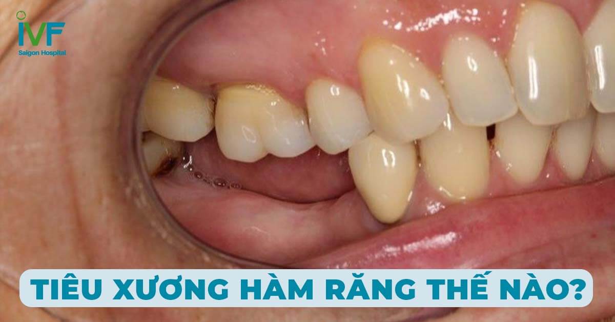 Tiêu Xương Hàm Răng Ảnh Hưởng Như Thế Nào?