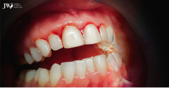 Phẫu thuật cười hở lợi ở đâu tốt?