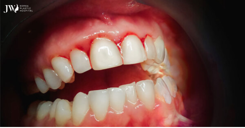 Viêm lợi có niềng răng được không?