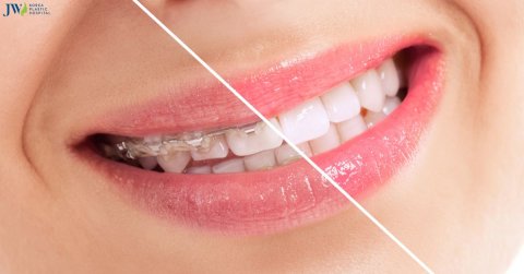 Có thể bạn chưa biết: Niềng răng làm răng yếu đi và lung lay!
