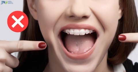 Mách bạn những thói quen xấu cần tránh khi niềng răng và giải pháp!