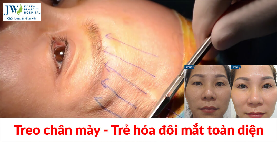 Treo chân mày: Trẻ hóa đôi mắt toàn diện chỉ với 45 phút 