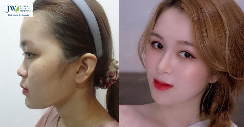 Phẫu thuật thẩm mỹ giúp cô nàng xinh đẹp tựa tiên nữ