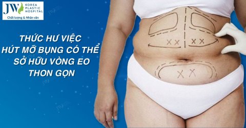 Thực hư hút mỡ bụng giảm được 15-20cm vòng eo
