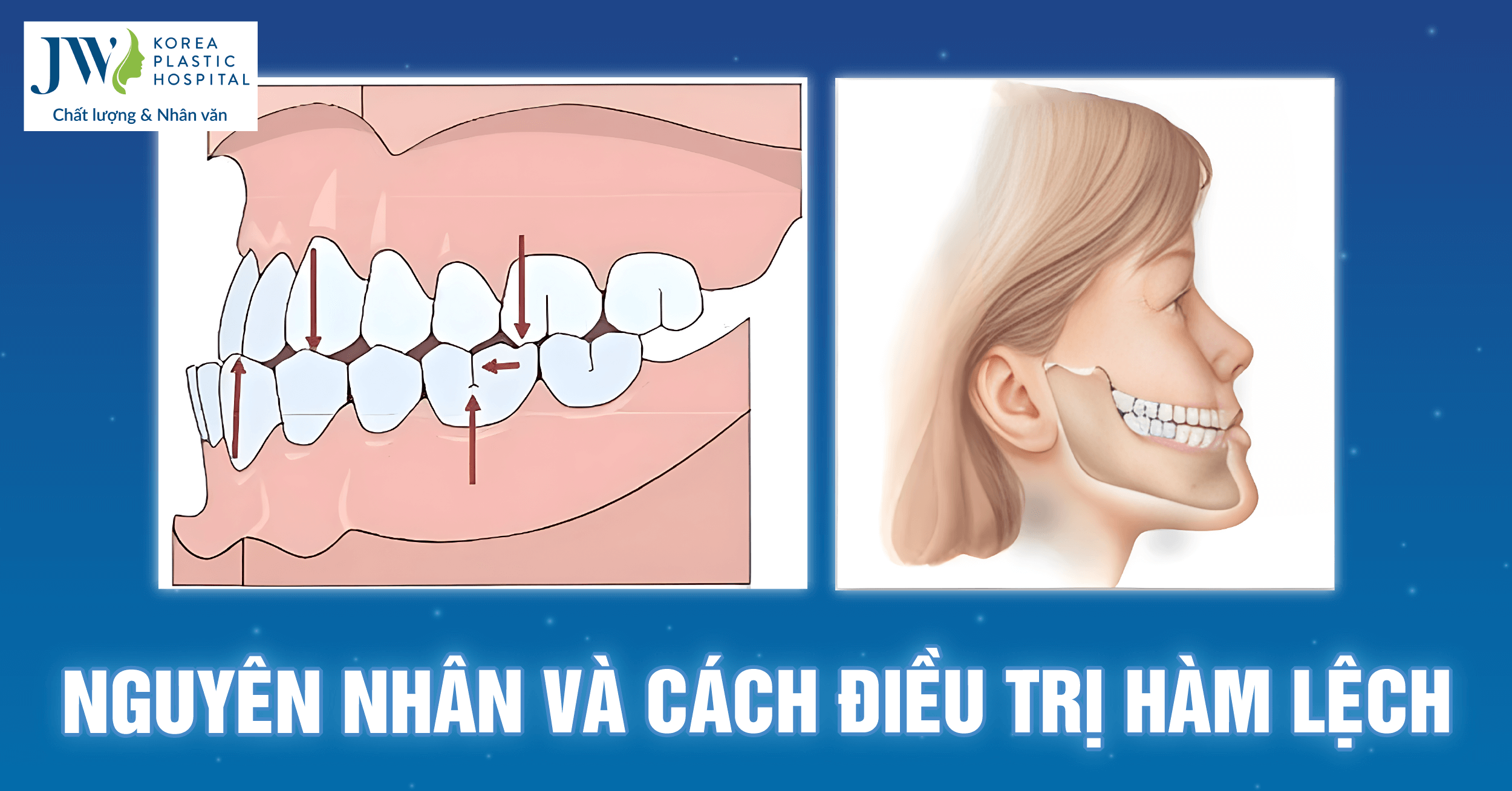 Nguyên nhân và cách điều trị lệch hàm