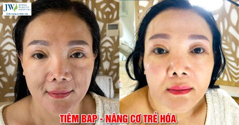 Vì sao Trẻ hóa căng bóng Profhilo được nhiều người lựa chọn?
