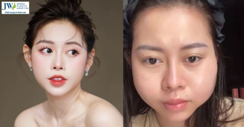 Hot TikToker Việt Phương Thoa bị lừa tiêm silicon khiến cô sống khổ sở suốt 6 năm qua