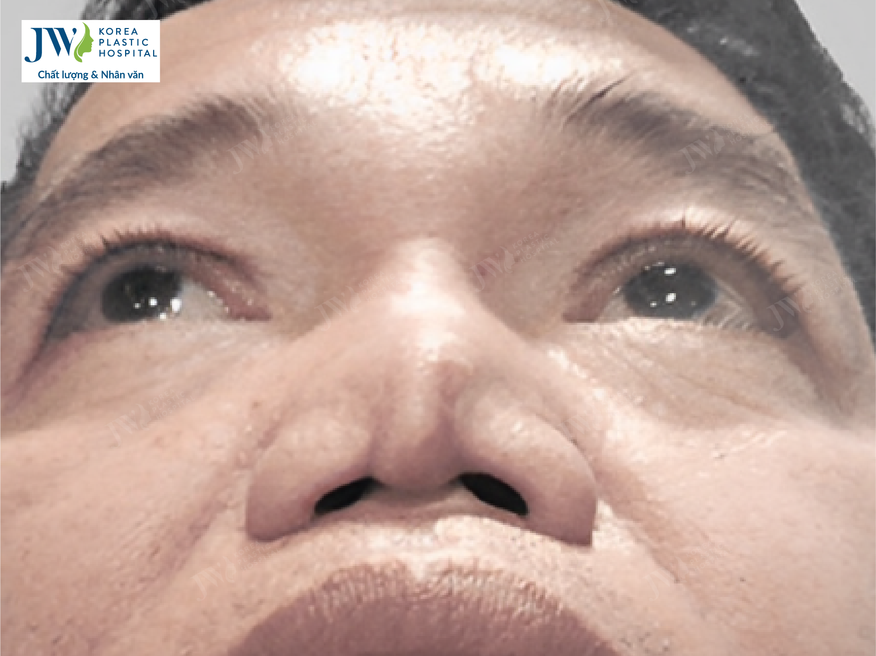 hinh-minh-hoa-bien-chung-nang-mui