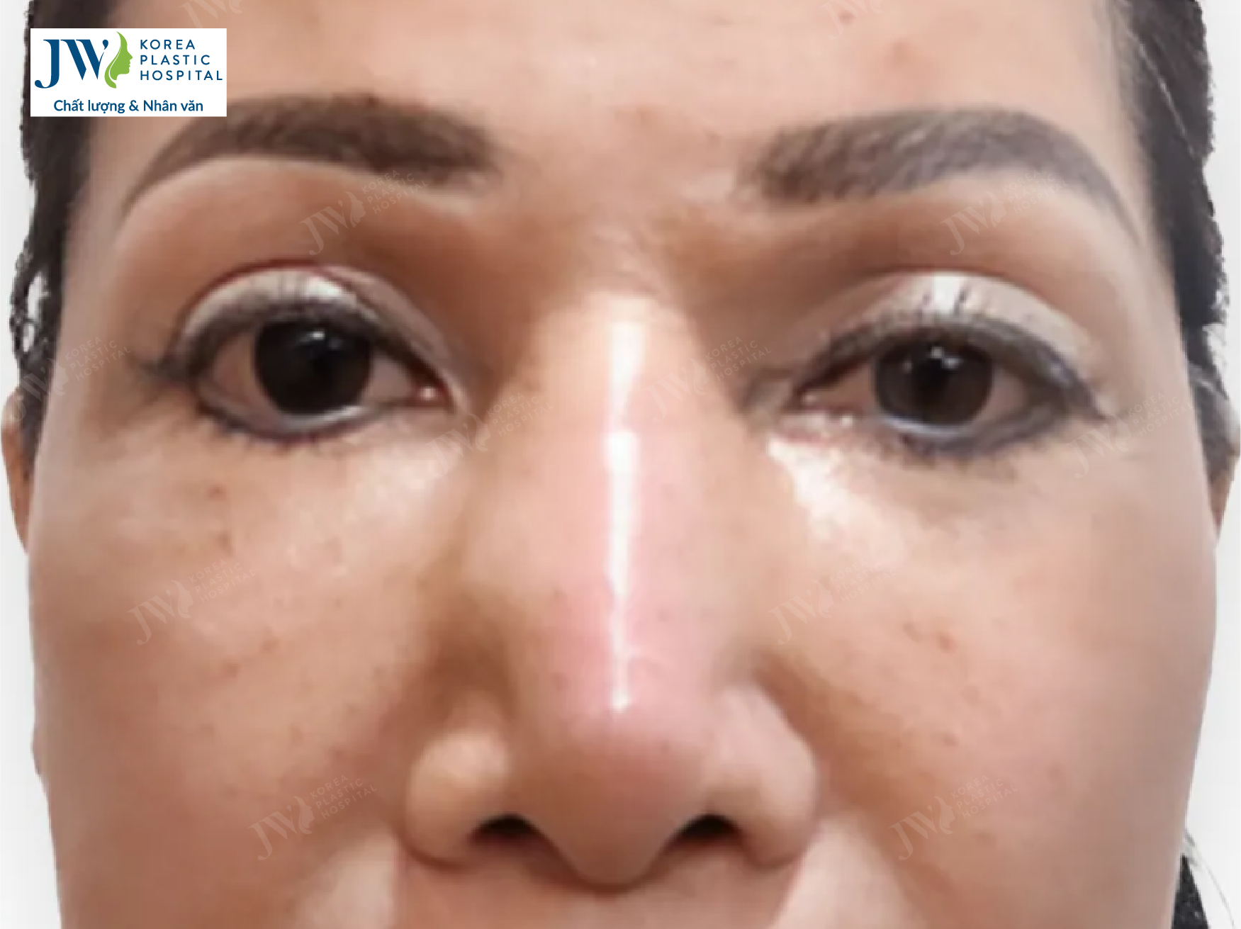 hinh-minh-hoa-bien-chung-nang-mui-01