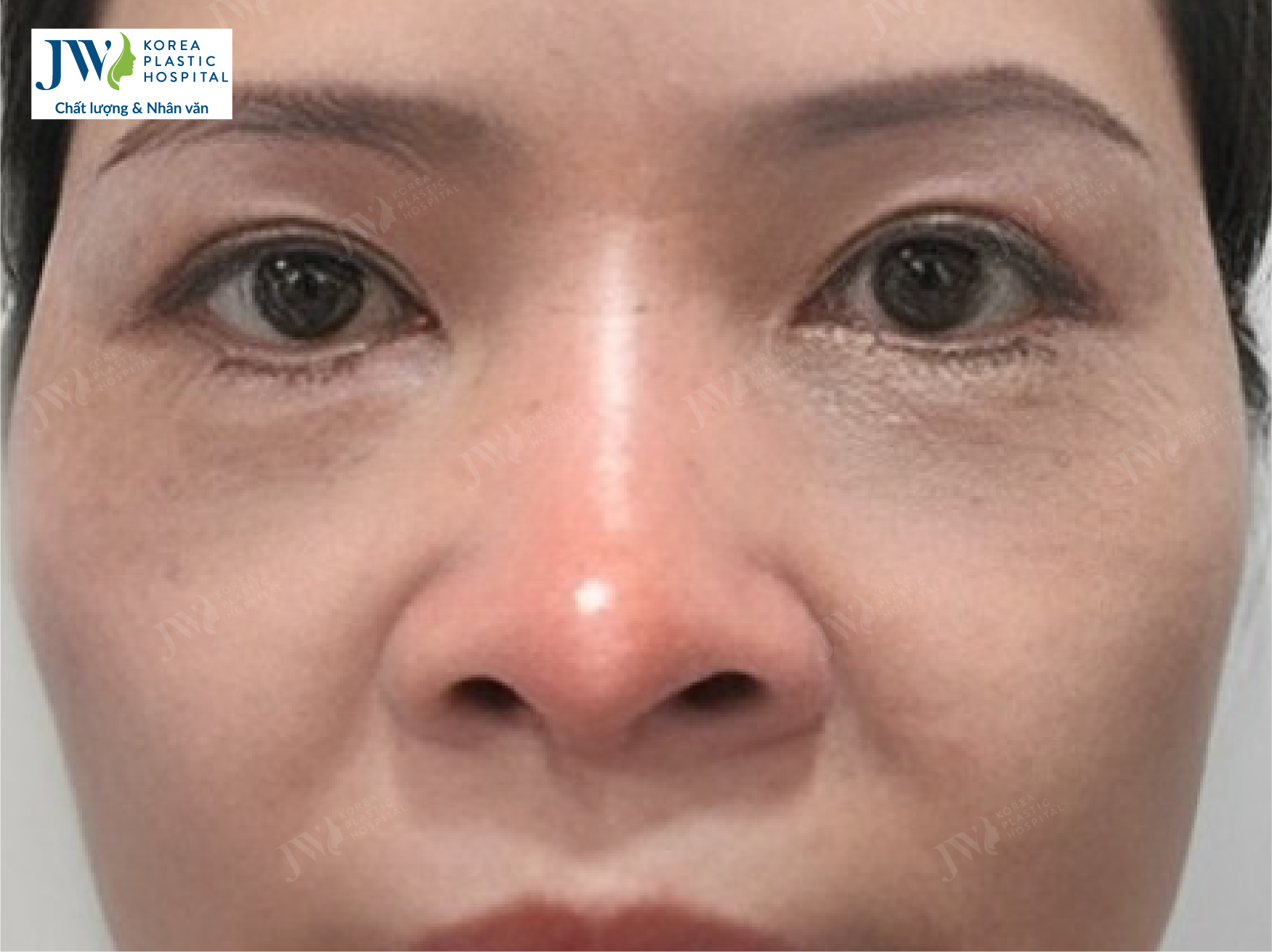 hinh-minh-hoa-bien-chung-nang-mui-02