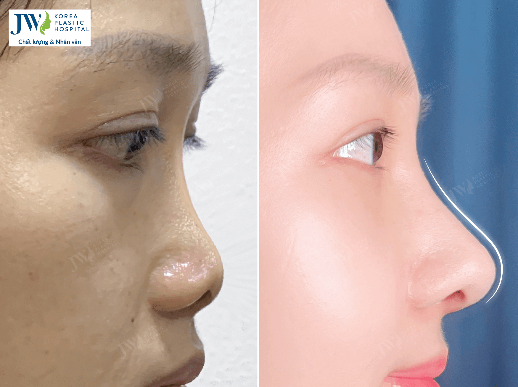 nang-mui-bang-sun-tu-than-benh-vien